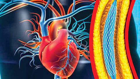 cardiac stent surgery