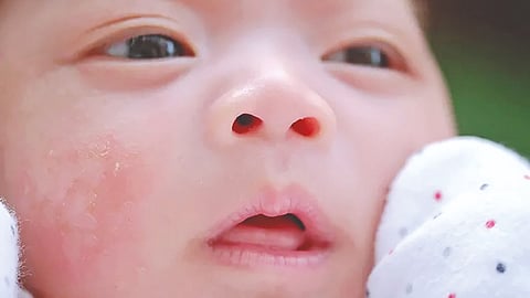 mycosis-in-newborn-babies