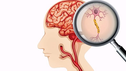 facing the challenge of brain hemorrhage