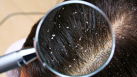 hair dandruff solution