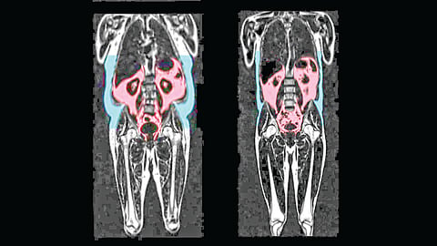 Hidden Body Fat Heart Risk