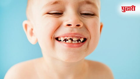 Baby Tooth Decay