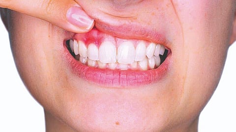 Dental Abscess