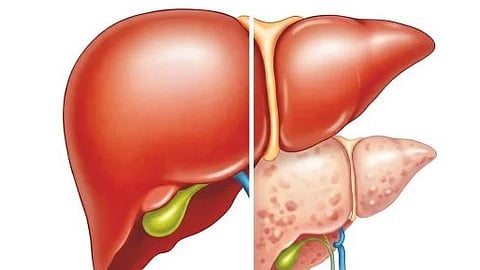 liver fat risk