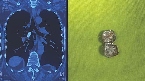 Dental cap inhaled