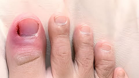 Pus In Toenail