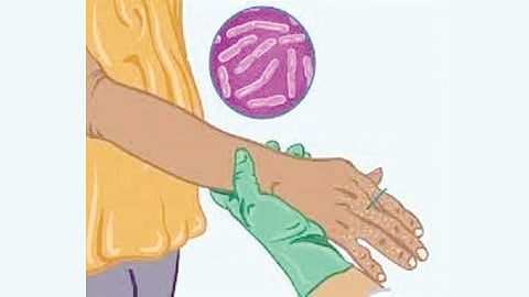 Leprosy detection campaign 2025