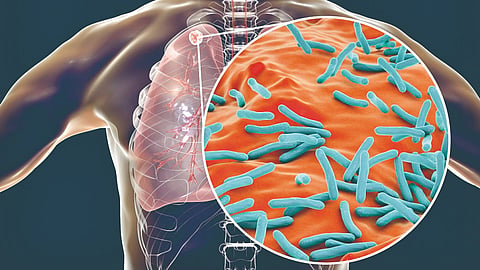Tuberculosis Treatment |