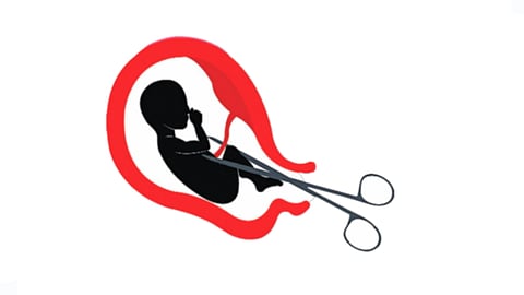 Fetal gender diagnosis, abortion case |