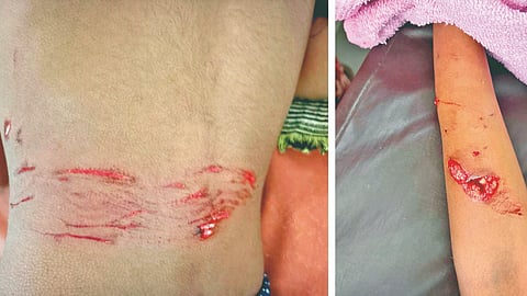 Stray dog attack
