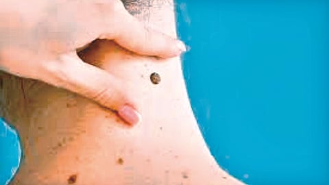 Skin tags |