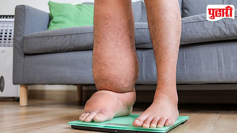 Elephantiasis