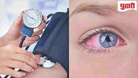 High Blood Pressure