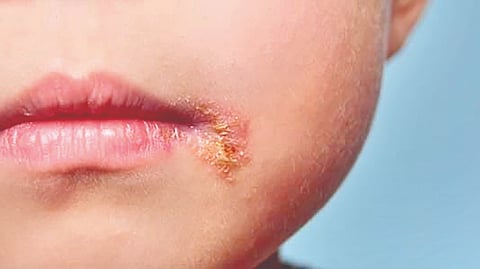 Children Skin Infections |