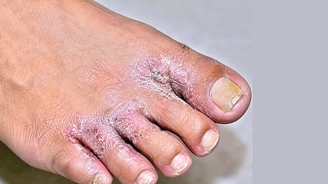 Fungal Infection |