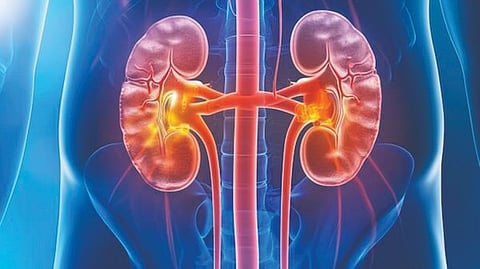 Kidney Transplant Waiting List