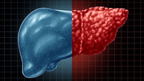 Fatty liver disease