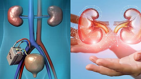 Artificial Kidney,