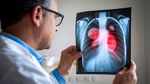 New Medication May Help Prevent Lung Cancer