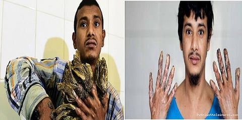 அரியவகை நோயில் இருந்து விடுதலையடைந்த மர மனிதன்..!