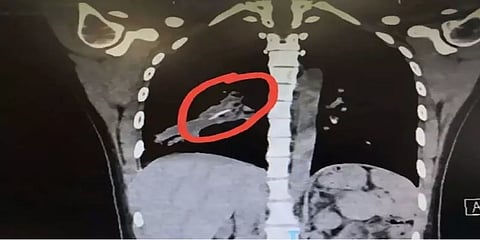 14 ஆண்டுகளாக பெண்ணின் நுரையீரலில் சிக்கியிருந்த ‘சிக்கன் பீஸ்’..!