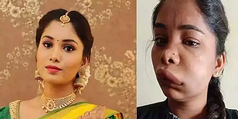 தவறாகிப்போன சிகிச்சை - முகம் வீங்கியதாக கன்னட நடிகை புகார்