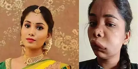 தவறிப்போன பல் சிகிச்சையால் கதறும் நடிகை - ரூட் கேனல் சிகிச்சை தவறானால் என்னவாகும்?