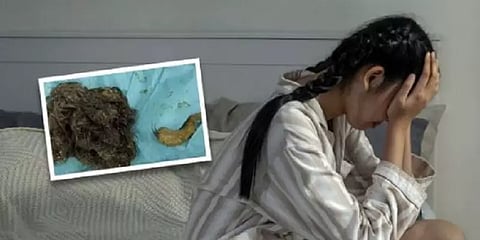 ”உணவுக்கு இடமில்லை” - சிறுமியின் வயிற்றுக்குள் 3 கிலோ தலைமுடி.. இது என்ன புதுவித வியாதி?