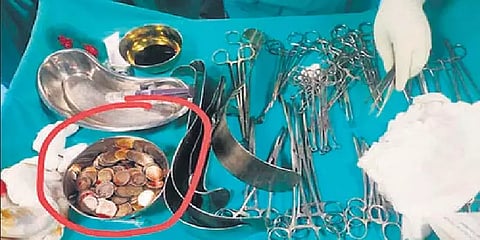 வயிறா இல்ல உண்டியலா? - 187 காயின்களை விழுங்கிய கர்நாடக நபர்... ஏன் தெரியுமா?