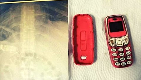बापरे! युवकाने नोकिया 3310 फोनच गिळला