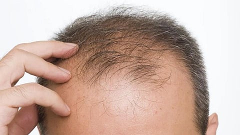 Bald Youth