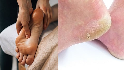 Cracked heels tips in marathi