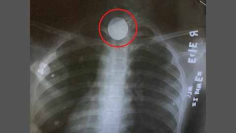 Coin Stuck In Throat