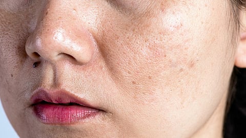 pigmentation problem, skin care problem