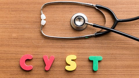 Ovarian cysts, Health issue, Benefits of yoga