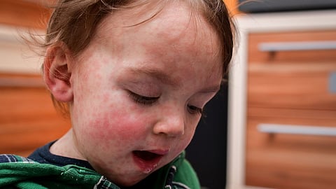 Measles Disease