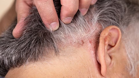 Skin Infections