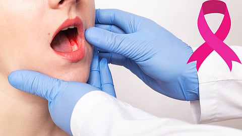 Mouth Cancer