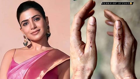 Samantha Ruth Prabhu Injured