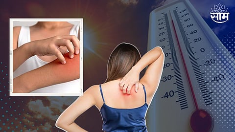 Sweat Rash Home Remedies