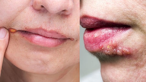 Pimples On Lips