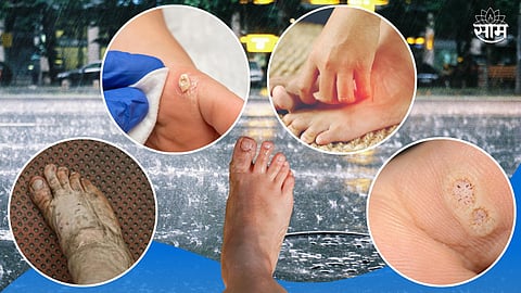 Leptospirosis
