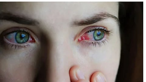 Eye Flu