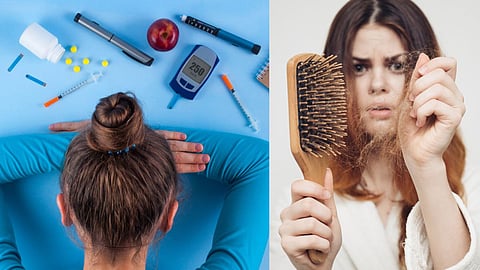 Diabetes Hair Falls