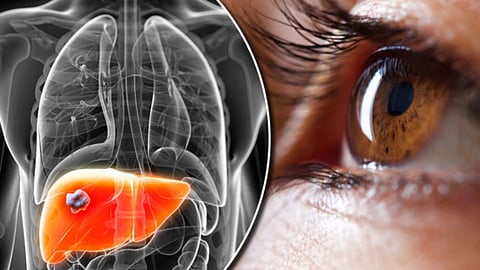 Liver Disease