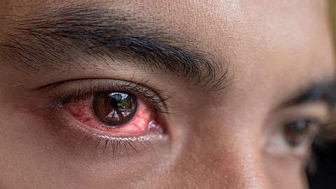 Crimean-Congo Disease