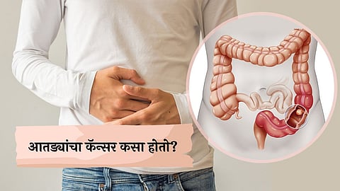 Colon Cancer Causes