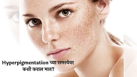 Hyperpigmentation च्या समस्येवर रामबाण ठरेल मध, अशाप्रकारे करा वापर