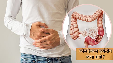 Colon Cancer Causes: कोलोरेक्टल कर्करोग कसा होतो? जाणून घ्या याच्या विविध टप्प्यांविषयी