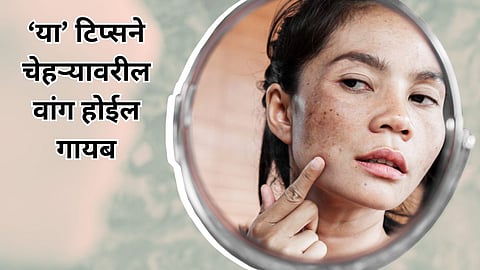 Black Pigmentation on Face